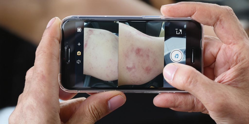 Person documenting injuries after a car accident.